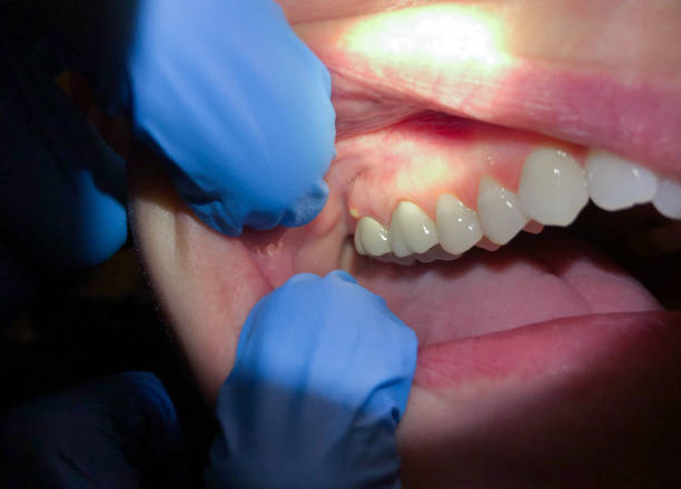 Best Emergency Gum Treatment in Morgans Point Resort, TX